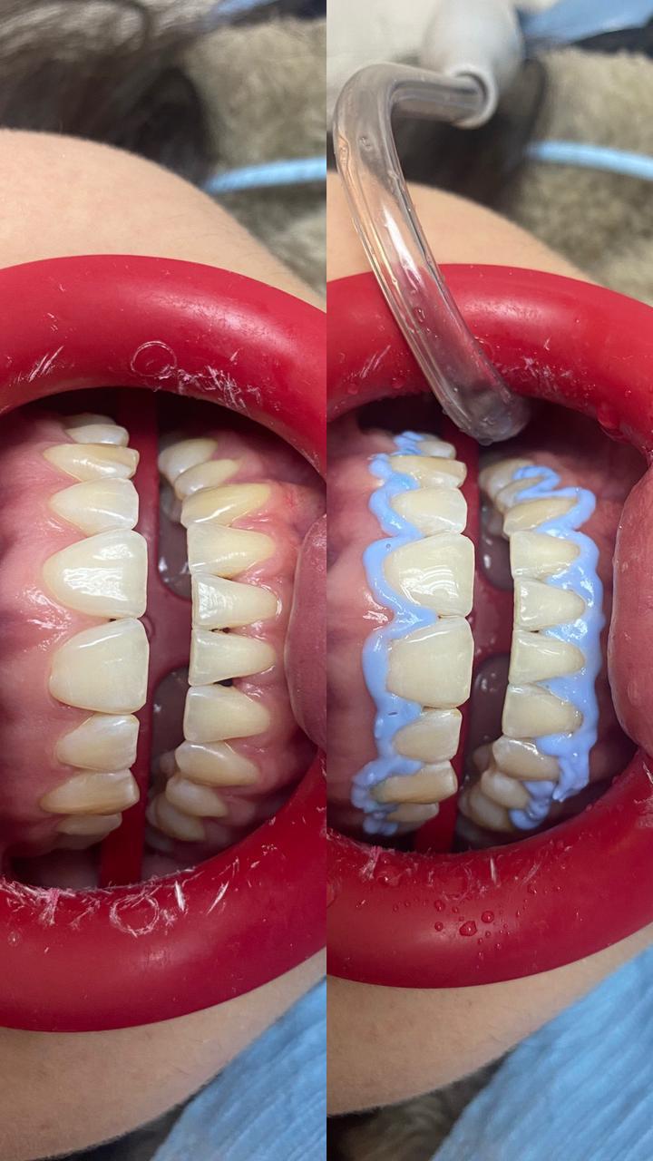 Blanqueamiento dental