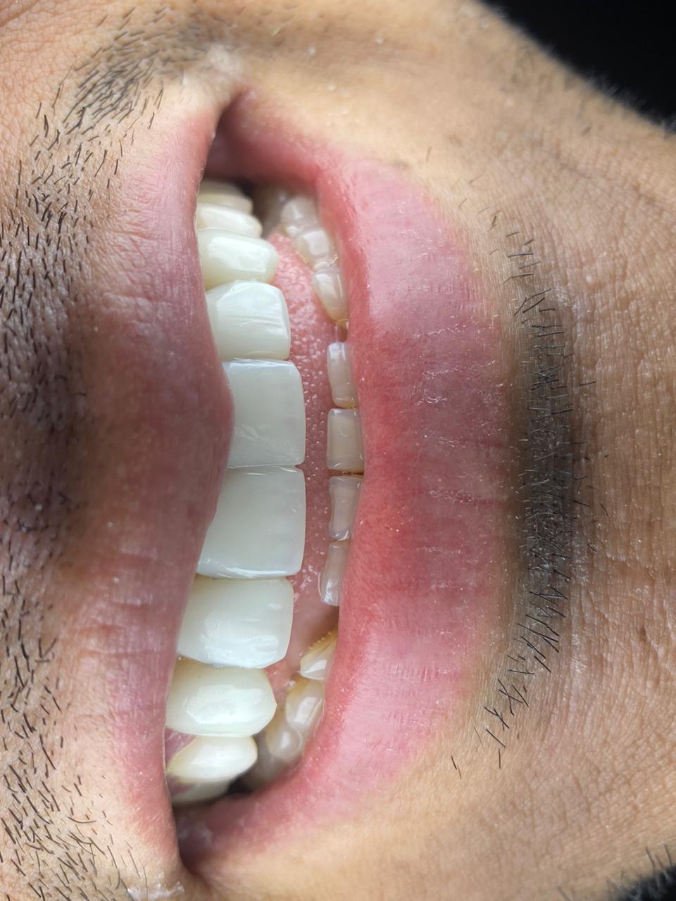 Diseño de sonrisa - Resinas - Despues