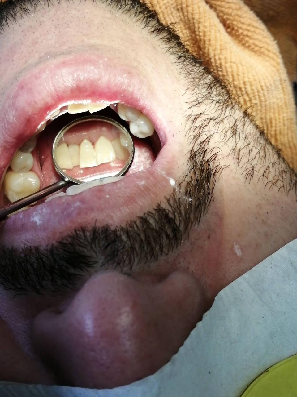 Limpieza dental (despues)